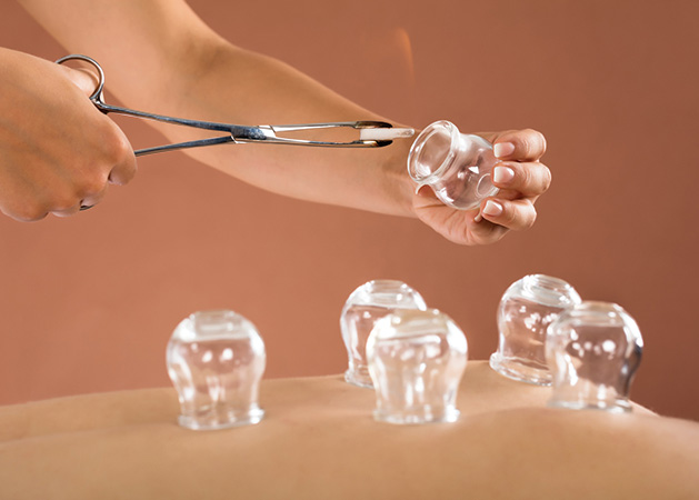 Heated glass containers are placed on a person's back in a practice known as cupping.